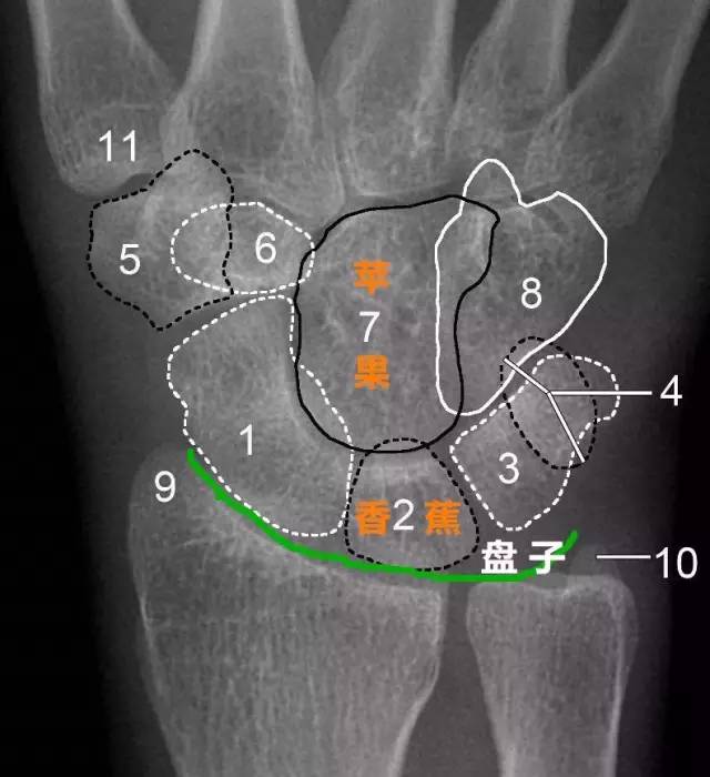 青少年尺腕关节脱位x线诊断标准,腕关节侧位x线片读片技巧