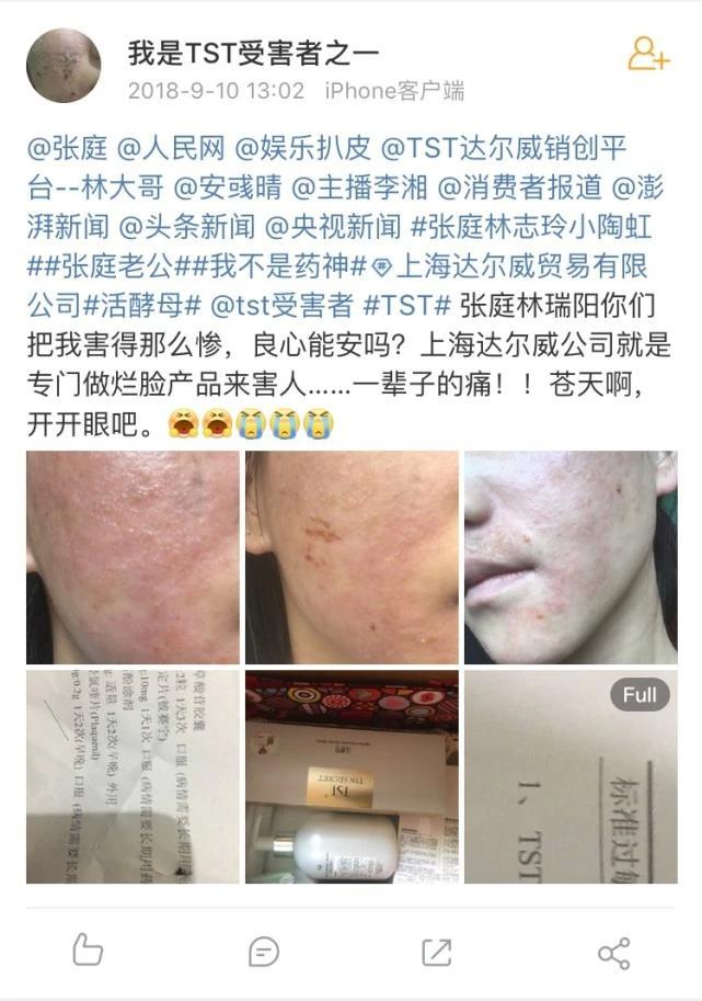 明星光环下的TST受害者：有人脸脱皮六次，有人纱布捆手防抠脸