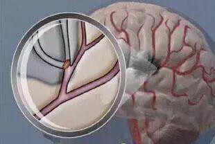 紧急救治脑卒中患者,医院真实脑卒中急救