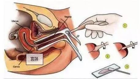 三年一做的妇科检查,今年妇科检查几月份开始检查