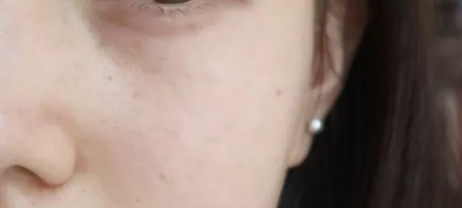 5个祛斑小妙招淡化晒斑雀斑痘印,痘印晒斑和疤痕用什么产品比较好