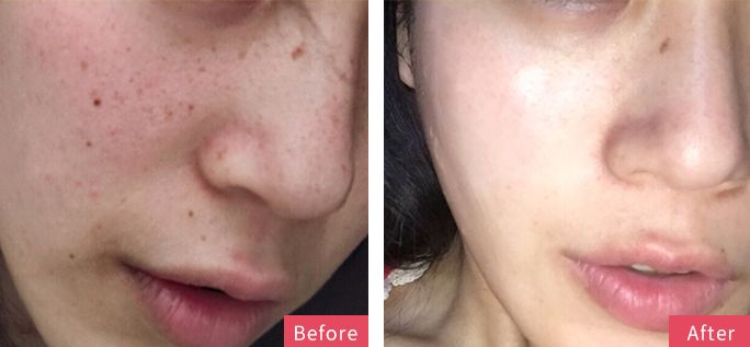 5个祛斑小妙招淡化晒斑雀斑痘印,痘印晒斑和疤痕用什么产品比较好