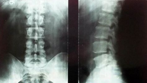 强直性脊柱炎治不好的原因,强直性脊柱炎压缩性骨折特点
