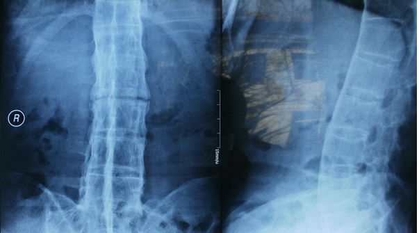 强直性脊柱炎治不好的原因,强直性脊柱炎压缩性骨折特点