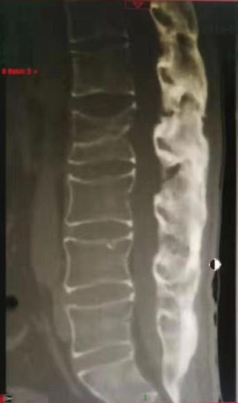强直性脊柱炎治不好的原因,强直性脊柱炎压缩性骨折特点