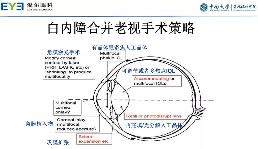 大师讲堂预告丨连续视程白内障手术治疗散光的关键要点-公式选择和手术松解要点