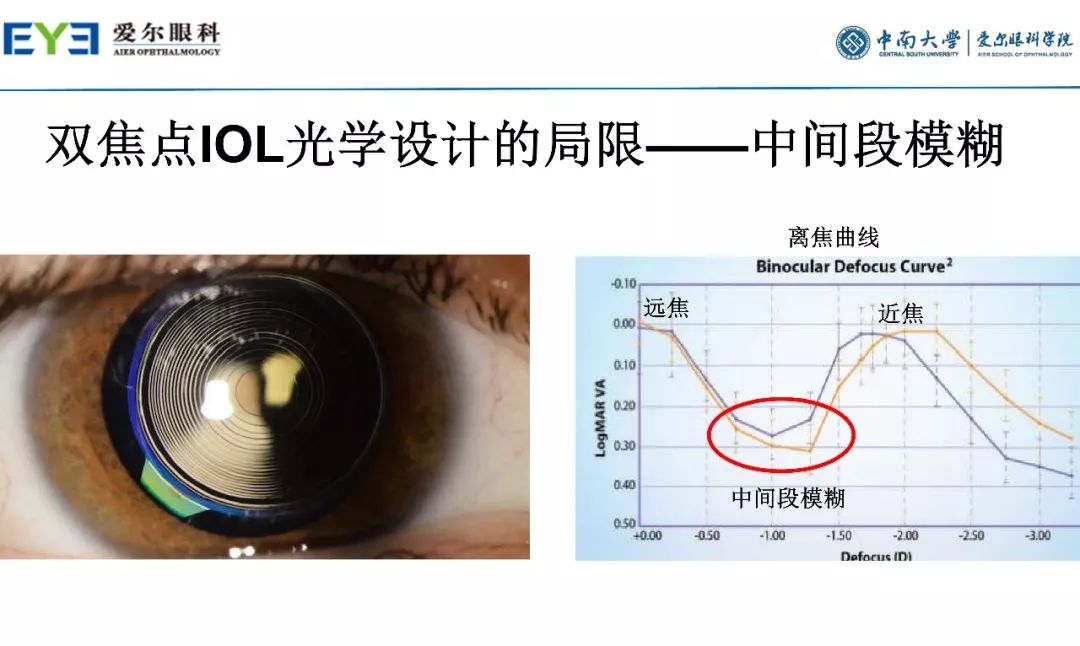大师讲堂预告丨连续视程白内障手术治疗散光的关键要点-公式选择和手术松解要点
