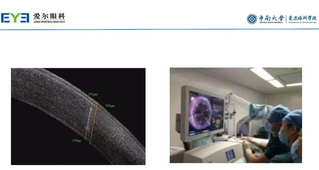 大师讲堂预告丨连续视程白内障手术治疗散光的关键要点-公式选择和手术松解要点