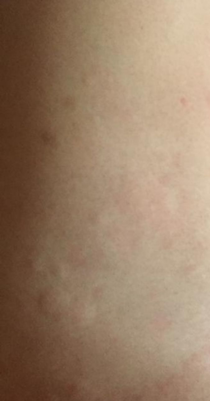 中医治疗荨麻疹一定要透疹,荨麻疹止痒大揭秘