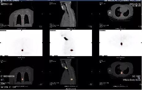 甲状腺癌远处转移碘131效果好吗,甲状腺癌转移远处tg会有变化吗