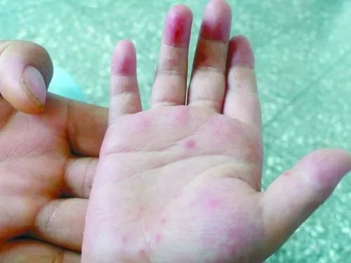 夏季宝宝湿疹高发新手妈妈看过来,婴儿特殊类型的湿疹以及皮炎