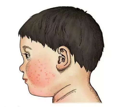 夏季宝宝湿疹高发新手妈妈看过来,婴儿特殊类型的湿疹以及皮炎