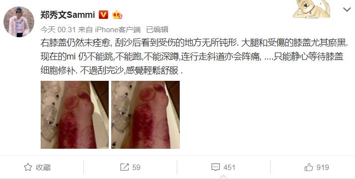 郑秀文腿伤,47岁郑秀文曝身体现状