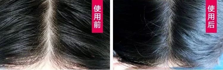 拯救发际线增加发量洗发水,生发发际线的神器测评