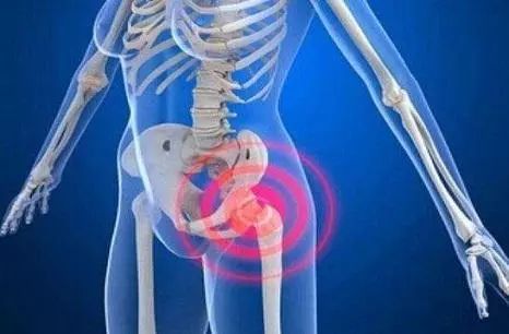 差点被误诊,髋关节炎大腿根疼