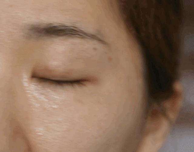 埋线双眼皮分叉修护动作,双眼皮埋线术后关注事项大全