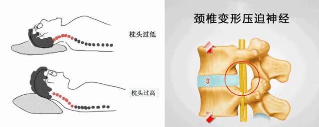 颈肩腰疼用什么热敷,颈肩腰痛小偏方