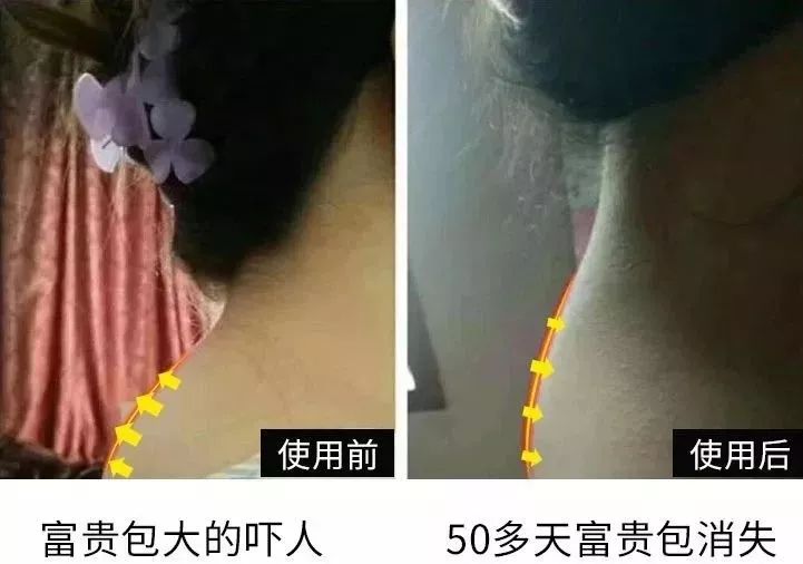 颈肩腰疼用什么热敷,颈肩腰痛小偏方