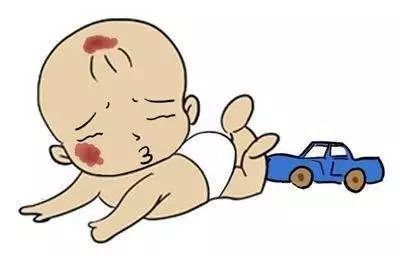 婴幼儿血管瘤红胎记治疗攻略,宝宝血管瘤胎记
