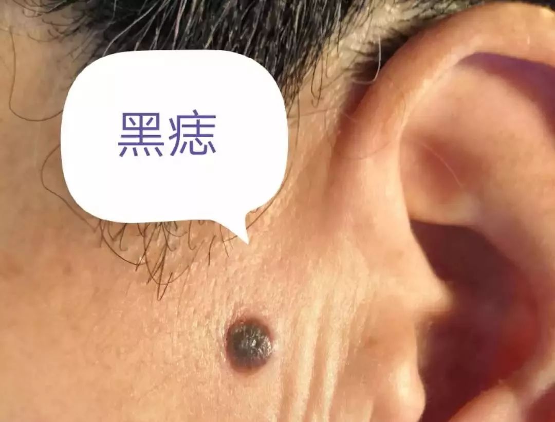 小小黑痣该不该治？该如何治？
