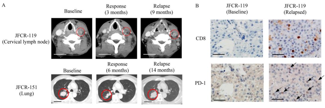 癌细胞“击落”PD-L1抗体！科学家发现癌细胞会分泌PD-L1片段，捕获PD-L1抗体，导致对免疫治疗产生耐药|科学大发现