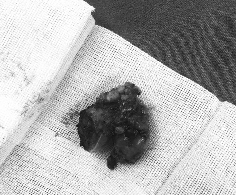 扁桃体肿瘤吞咽梗阻,喉咙肿块吞咽困难