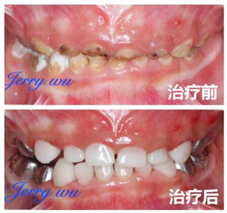 儿童一口牙全坏了但不痛,三岁半宝宝满口蛀牙怎么挽救