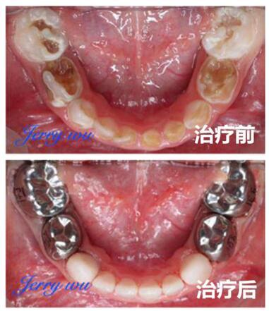 儿童一口牙全坏了但不痛,三岁半宝宝满口蛀牙怎么挽救
