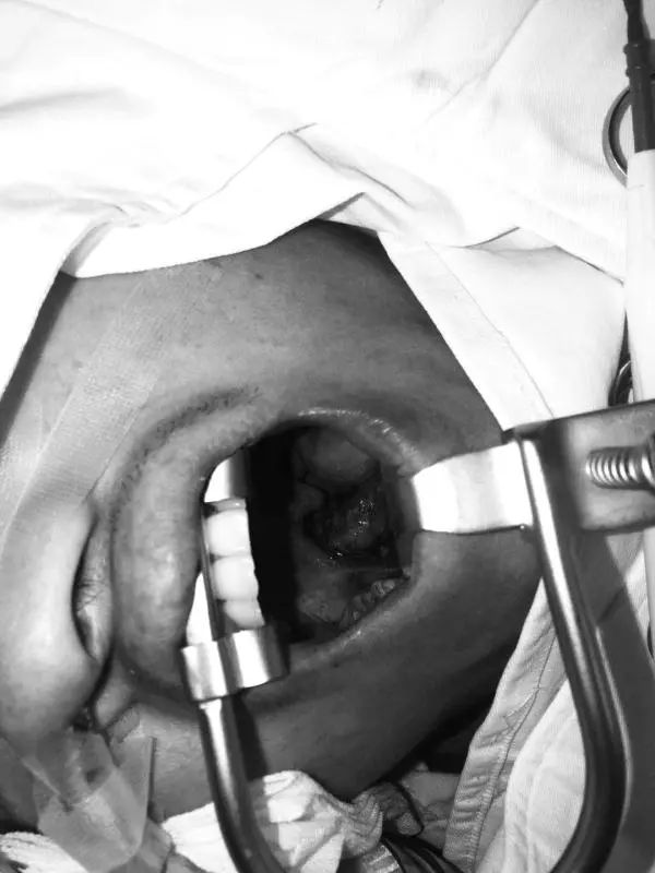 扁桃体肿瘤吞咽梗阻,喉咙肿块吞咽困难