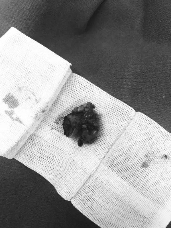 扁桃体肿瘤吞咽梗阻,喉咙肿块吞咽困难