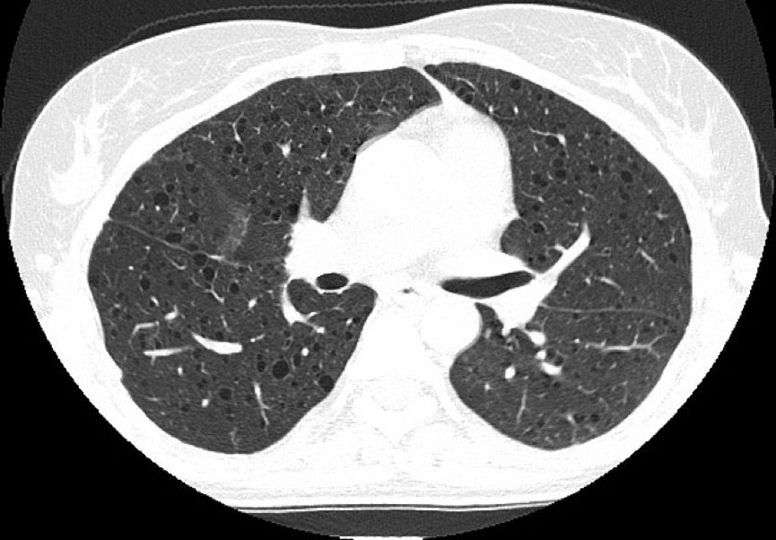 双肺上叶胸膜下见薄壁空腔正常吗,双肺多发类圆形薄壁透亮影严重吗
