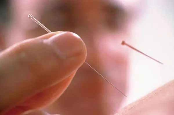 针灸可以用于麻醉，你知道吗？——写在针刺麻醉发展60余年