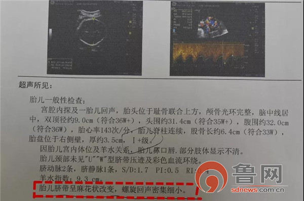 这个35+3周的宝宝出生时脐带扭成了麻花，且呈紫红色……