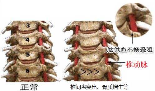 心悸胸闷头晕怎么回事,头晕心悸胸闷气短乏力嗜睡