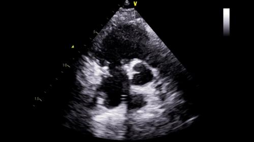 先天性心脏畸形如何治疗,常见先天性心脏畸形的外科治疗