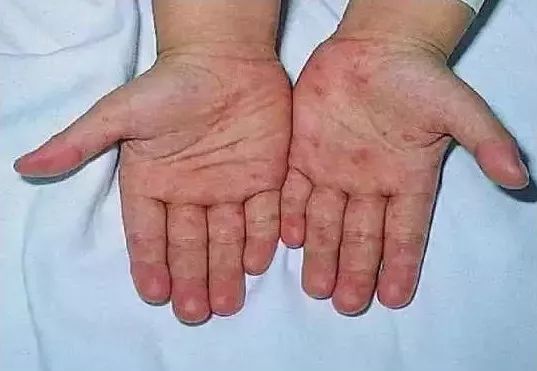 儿童季节性皮疹用什么药最好,儿童常见的出疹疾病