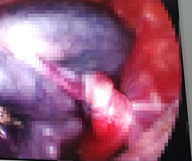 山东让女孩摘除输卵管,13岁女孩腹痛6天一侧输卵管坏死