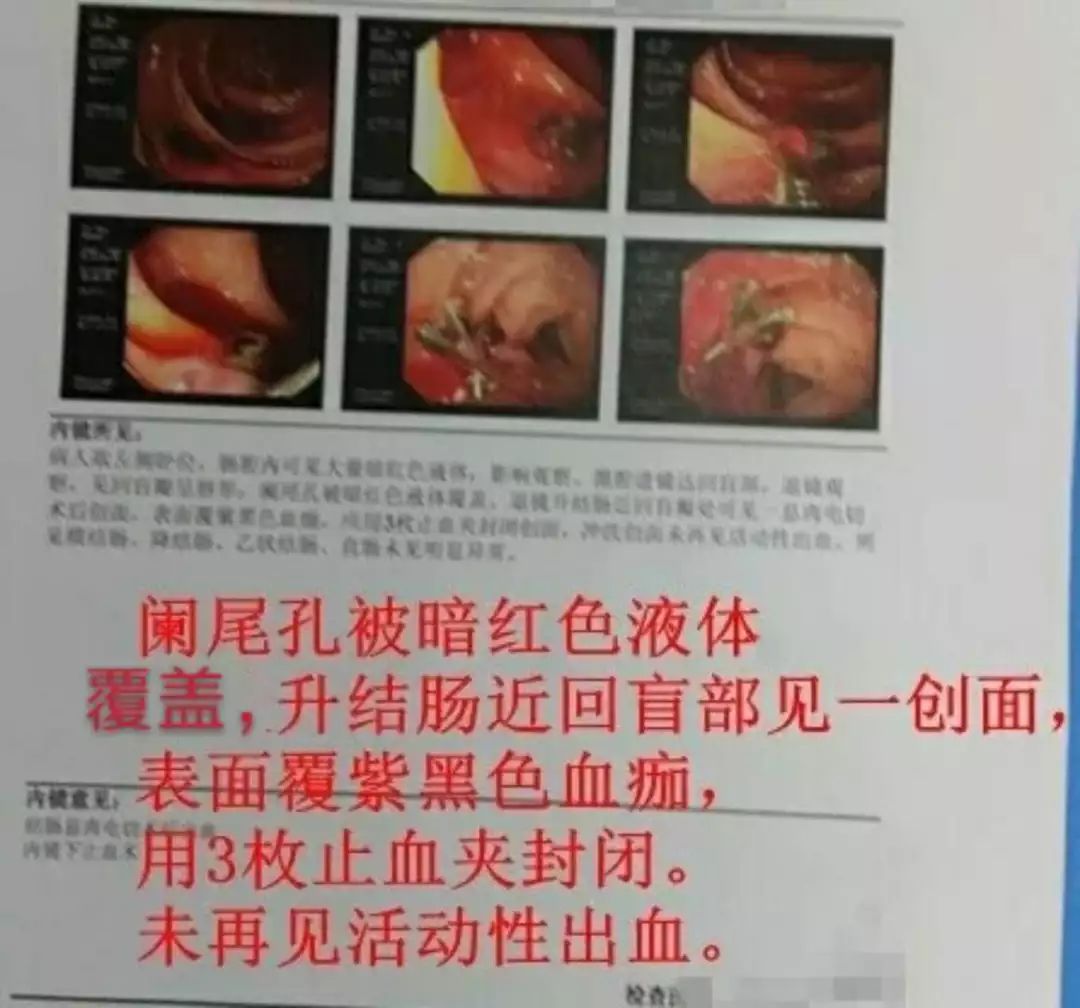 肠息肉迟发性出血与穿孔的时限,肠息肉切除后拉出血怎么治疗
