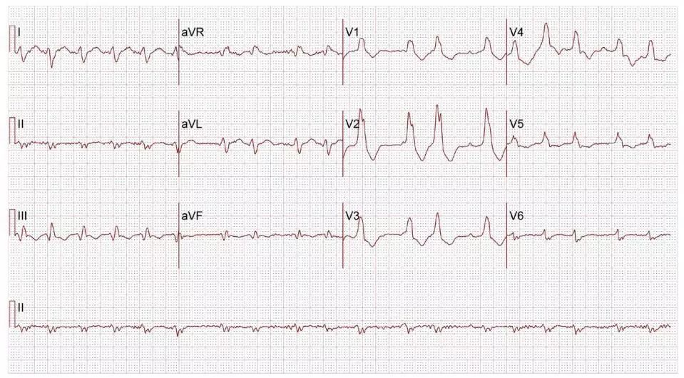 心电图提前出现宽大的qrs波,宽口qrs波心动过速的鉴别诊断