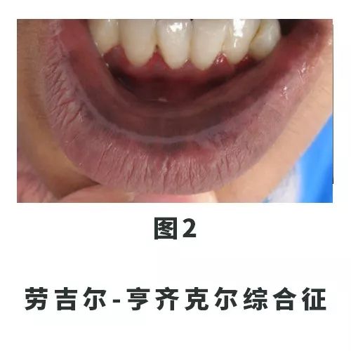 口唇出现黑斑是怎么回事,口唇内壁有黑斑