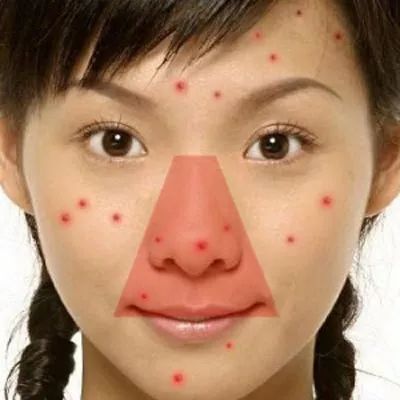 这个地方长痘千万别动！这起悲剧为所有人敲响警钟！