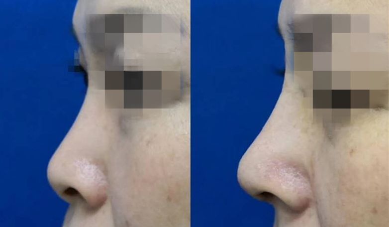 长鼻子如何通过整容改善,鼻子到底应该怎么修