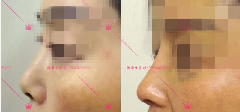 长鼻子如何通过整容改善,鼻子到底应该怎么修