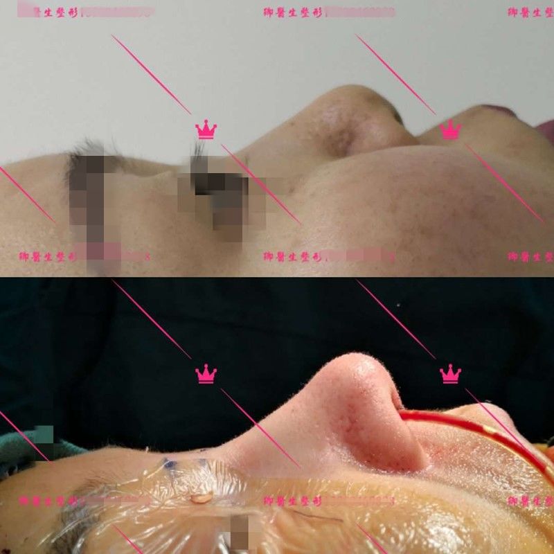 长鼻子如何通过整容改善,鼻子到底应该怎么修