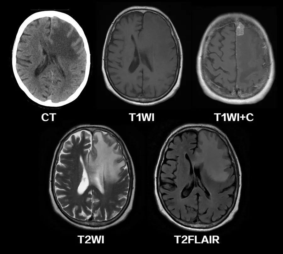 如何平稳度过脑水肿,多种原因导致的脑水肿首选是什么