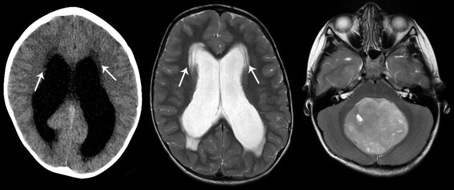 如何平稳度过脑水肿,多种原因导致的脑水肿首选是什么