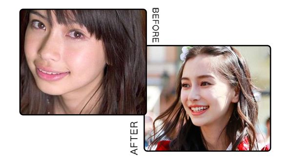 戴牙套换粗钢丝,拔四颗牙戴牙套的脸型变化图