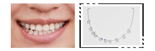 戴牙套换粗钢丝,拔四颗牙戴牙套的脸型变化图