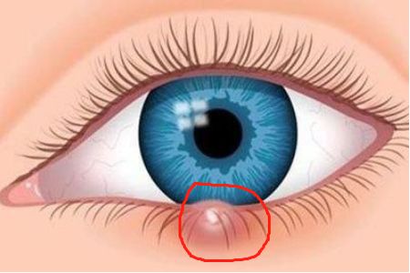 外伤眼睛肿了热敷还是冷敷好,眼睛上火肿了用冷敷还是热敷