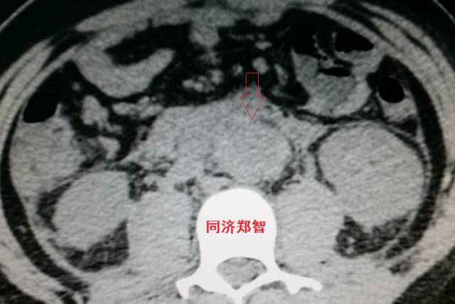 主动脉夹层cta能扫描出来吗,急性主动脉夹层cta影像诊断与鉴别